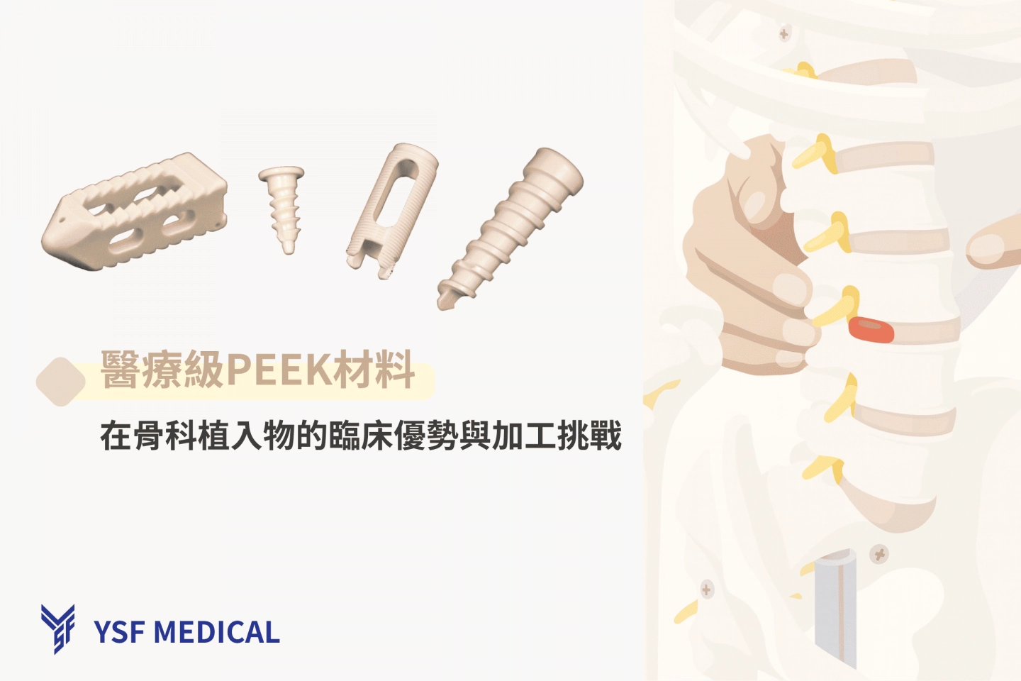 元信豐企業專精醫療級 PEEK 骨科植入物，包括脊椎融合器、螺釘與醫療器械，強調臨床優勢與加工挑戰，專業骨科植入物 OEM 製造商